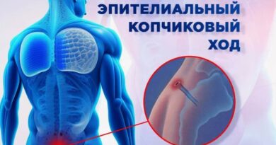 Эпителиальный копчиковый ход